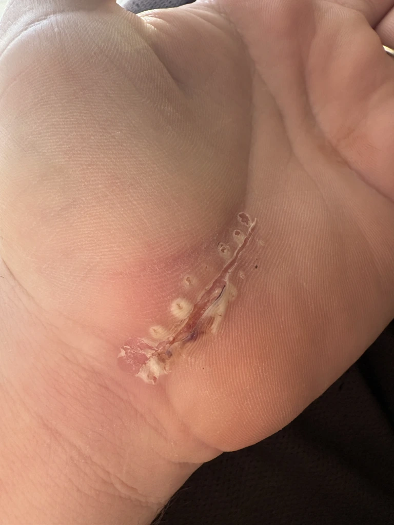 Wound 3 weeks after carpal tunnel surgery
